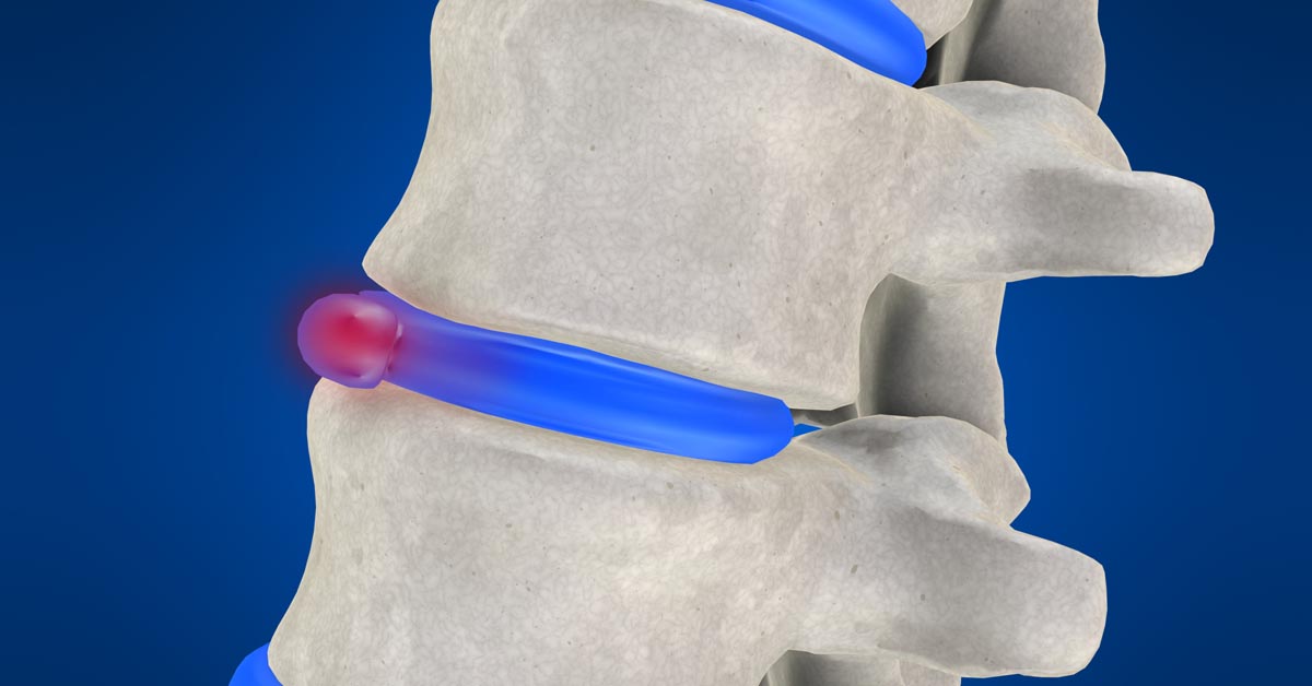 Massillon, OH non-surgical disc herniation treatment